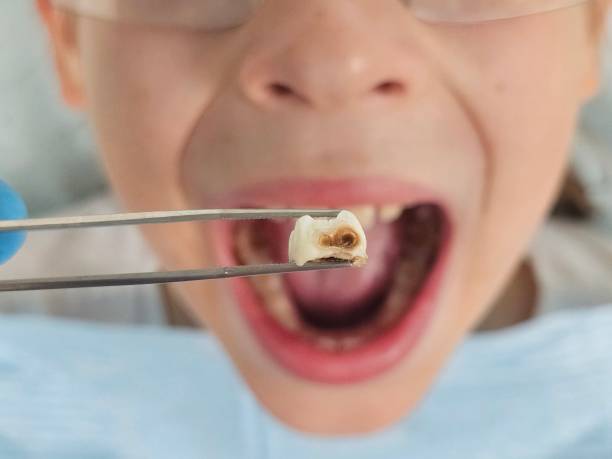Best Emergency Tooth Extraction in Nooksack, WA